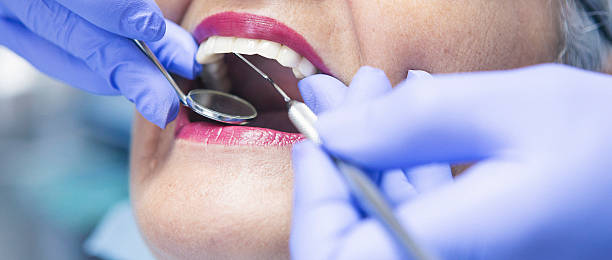 Best Emergency Root Canal Treatment in Fulton, IL
